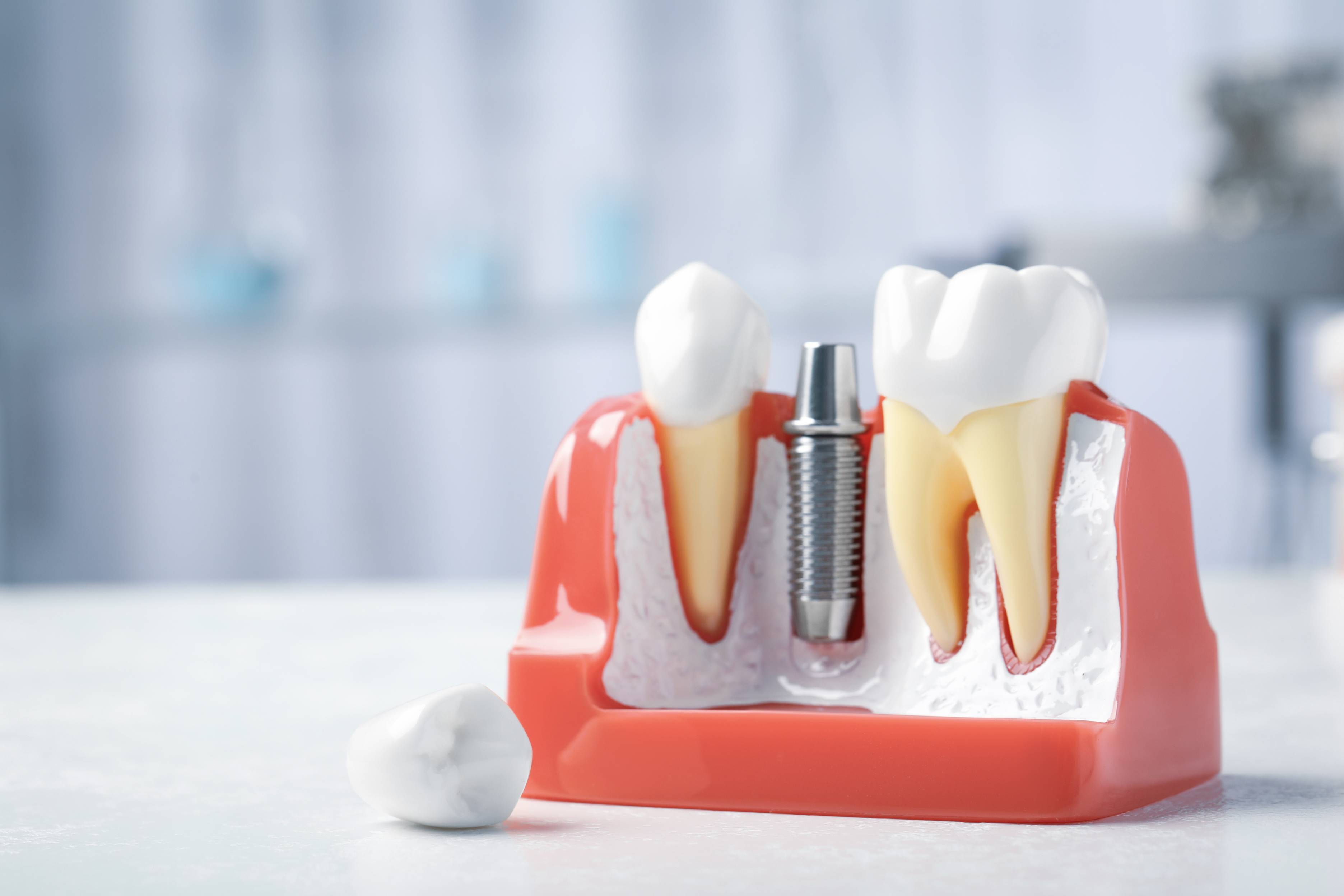 Dental Implants Dental Implants