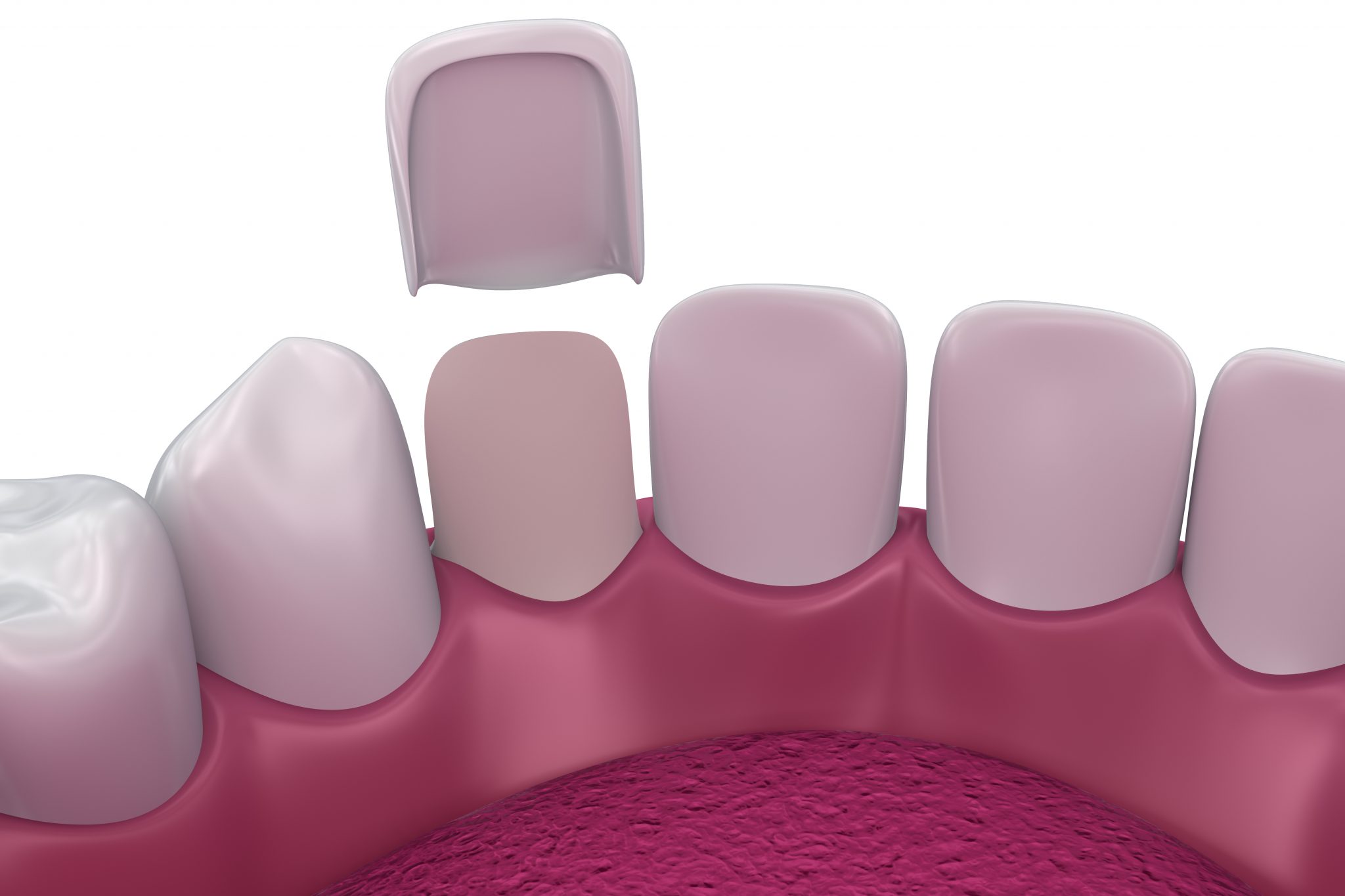 Porcelain Veneers Porcelain Veneers