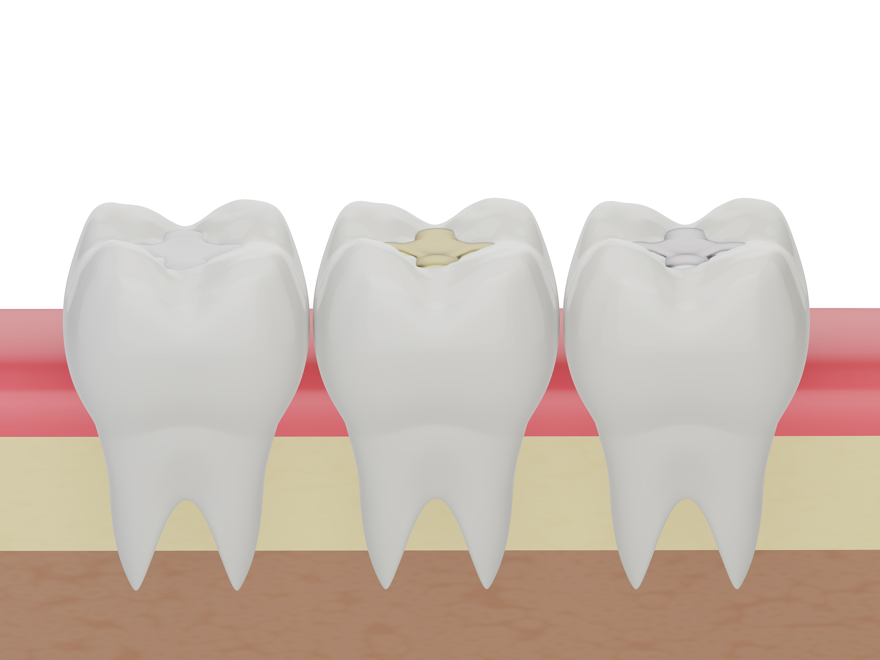 Dental Fillings Dental Fillings